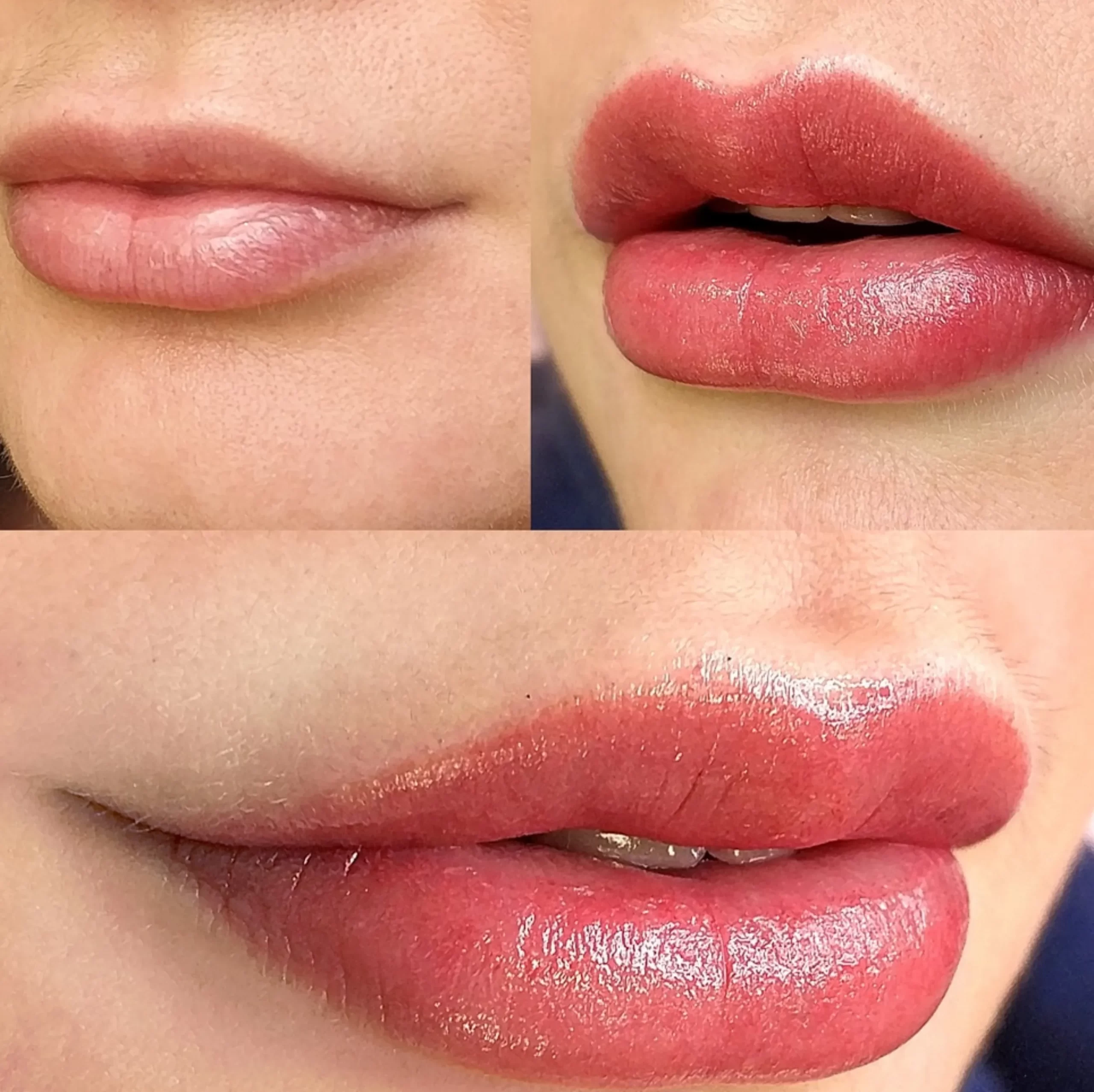 Lip fillers, Lip Tattoo Melbourne